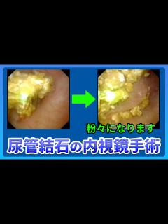 [x]腎臓結石・尿管結石に対する経尿道的内視鏡治療(TUL) #尿管結石 #泌尿器科 #TUL - YouTube