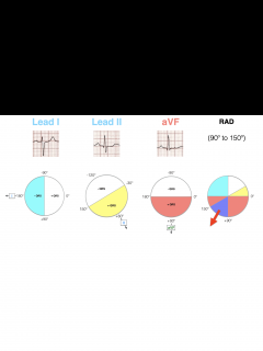 [x]Right Axis Deviation (RAD) • LITFL • ECG Library Diagnosis